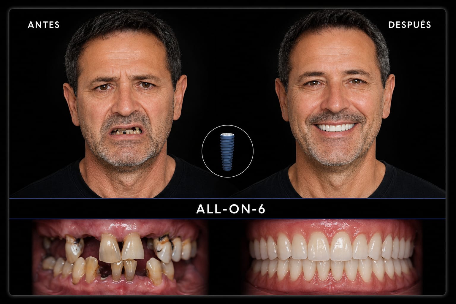 Antes y después — All-on-6